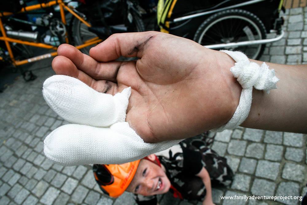 Cycle injury - hand caught in chain Cycle injury - hand caught in chain
